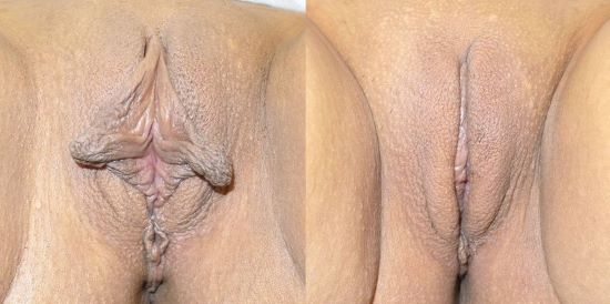 Labiaplasty Connecticut