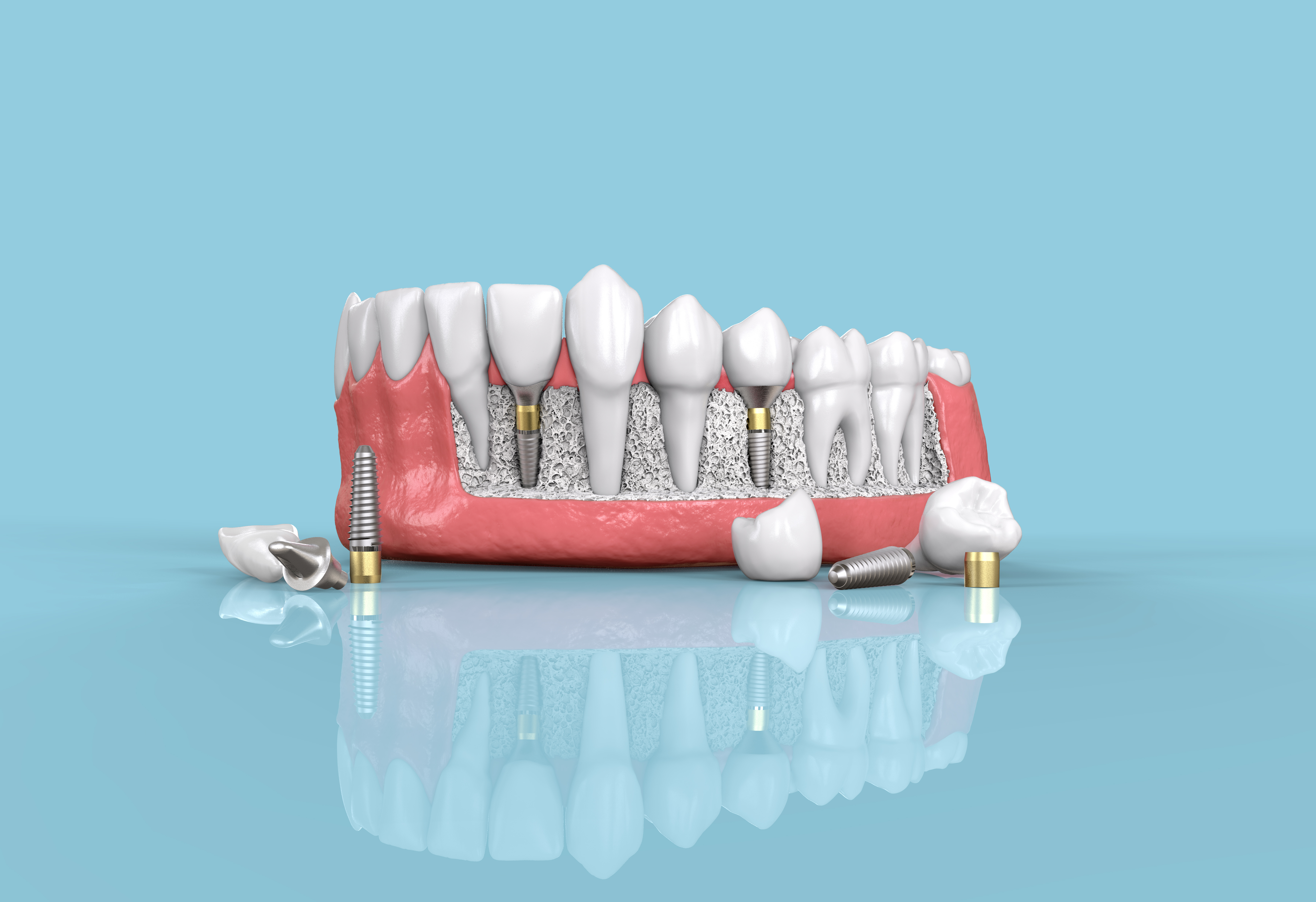 Implant denture