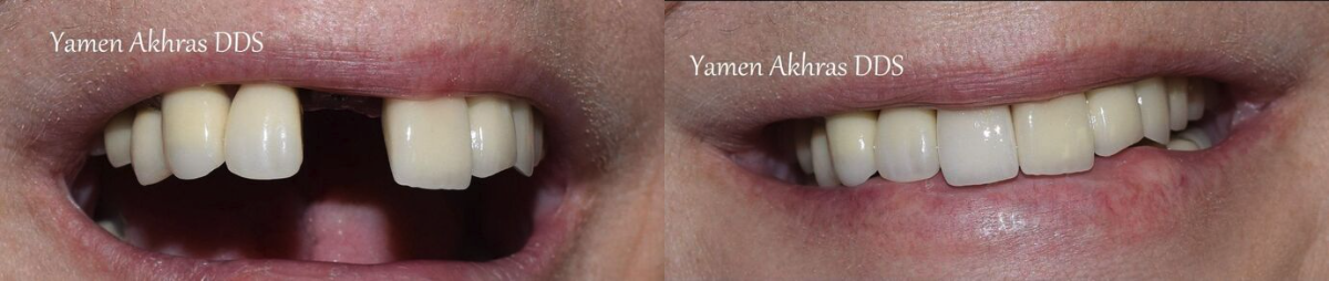 Patient before and after receive an implant-supported dental crown