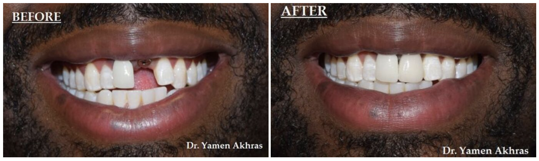 Before and after implants