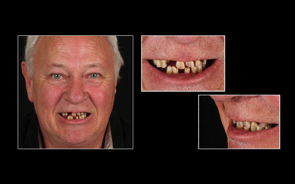 Before All-on-4 patient at Cosmetic & Implant Dentistry Center