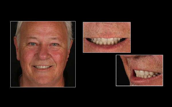 Before All-on-4 patient at Cosmetic & Implant Dentistry Center