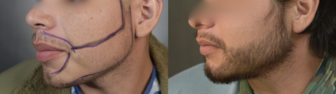 man with a full beard restored in Houston by Dr. Arocha