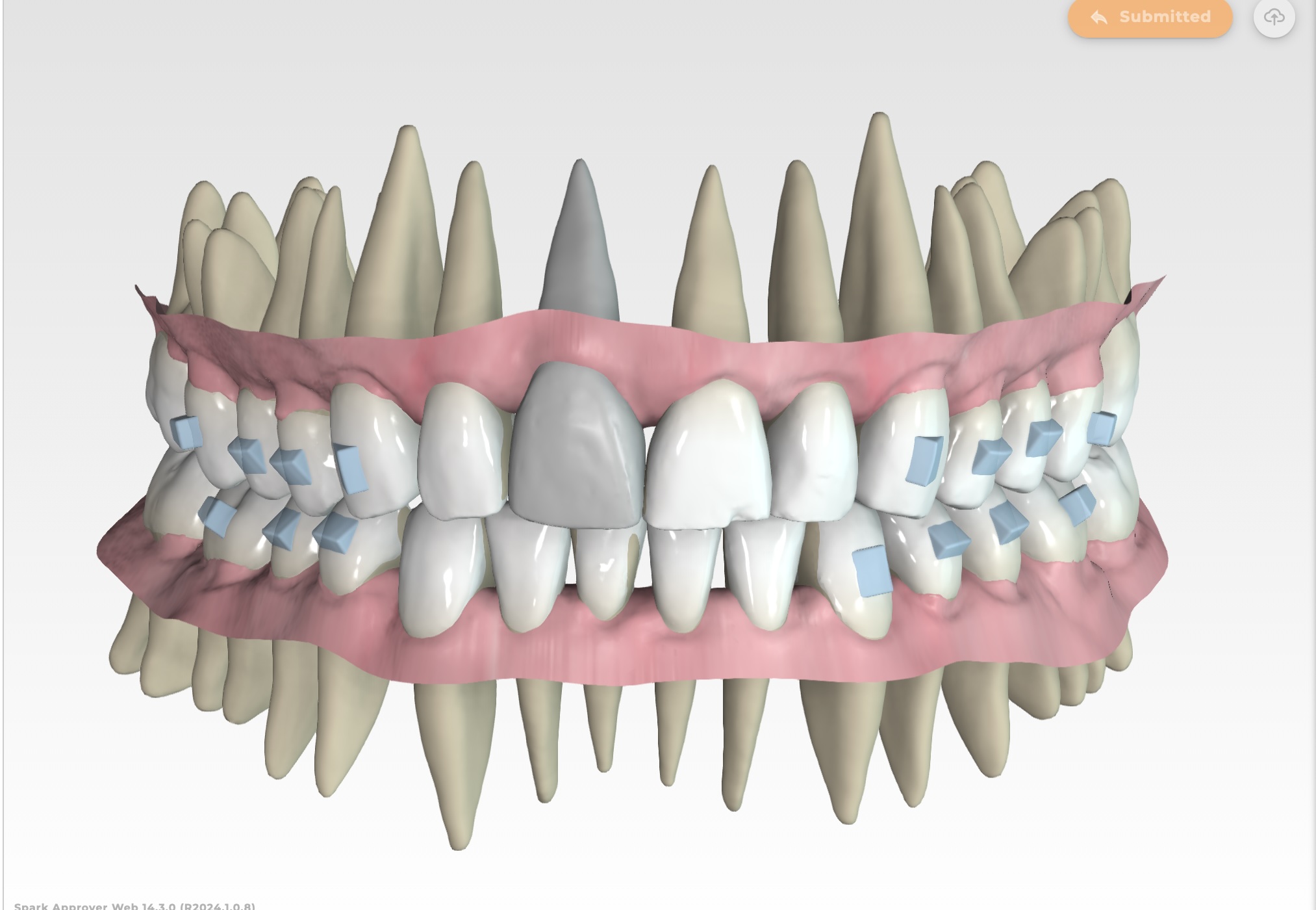 spark aligner Austin clear aligner dentist