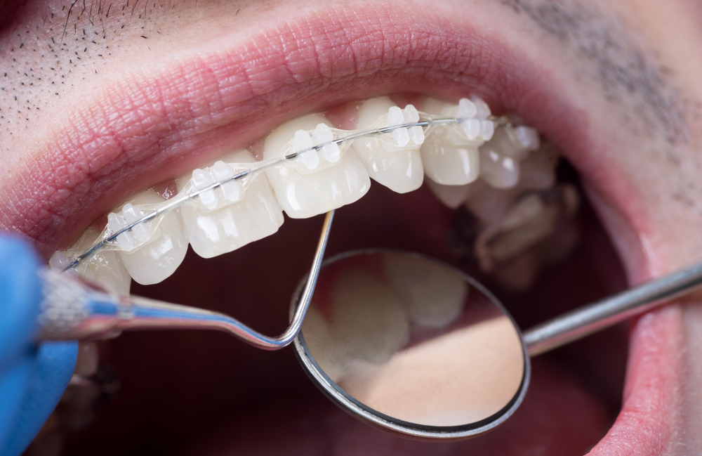 Young man with ceramic braces at dental appointment