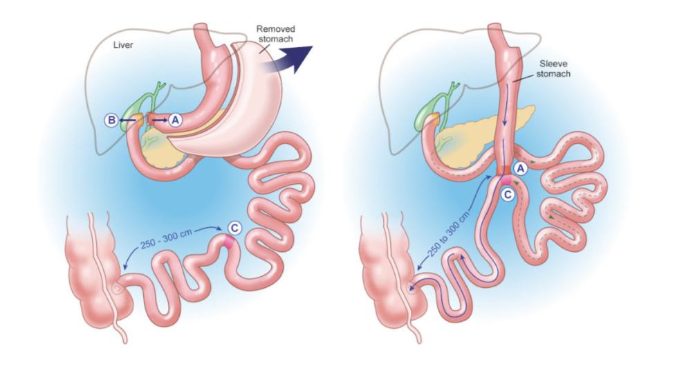 Visual representation of the SADI-S weight loss surgery procedure
