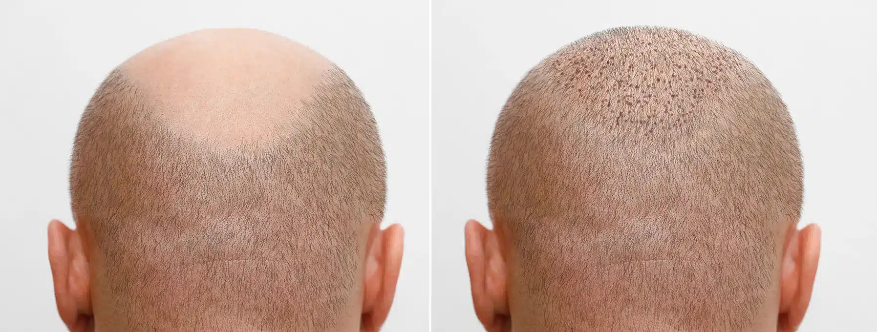 Before and After Hair Grafts