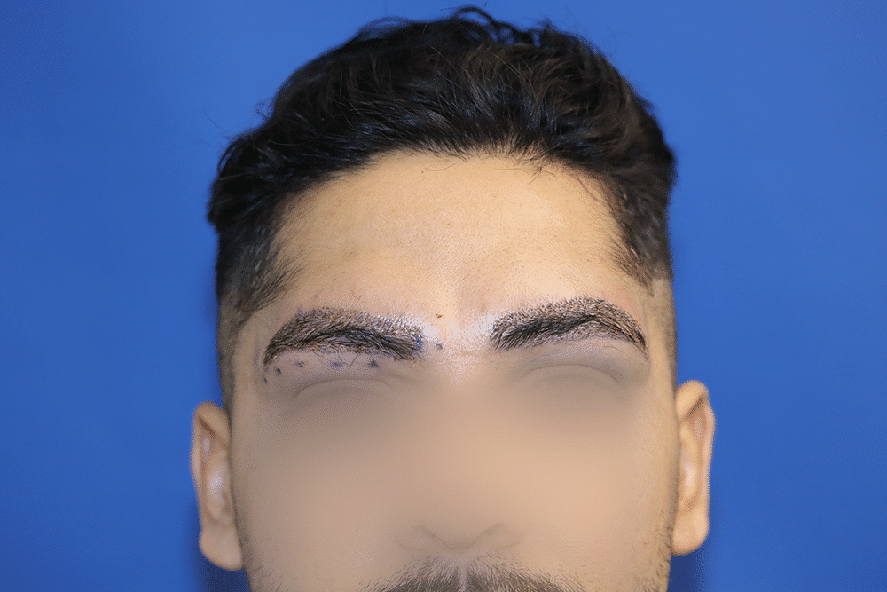 What to Expect When You Sign Up for an Eyebrow Transplant - BKS Hair Restoration
