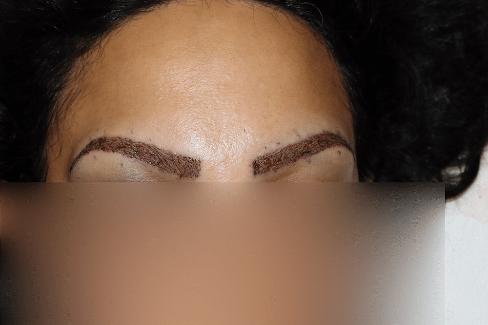 What to Expect When You Sign Up for an Eyebrow Transplant - BKS Hair Restoration