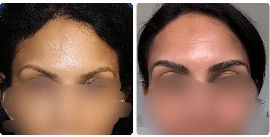 Eyebrow Restoration - Before and After photo - BKS Hair Restoration