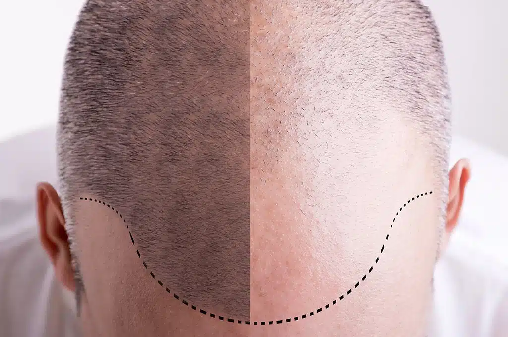 After and Before Hair Grafts