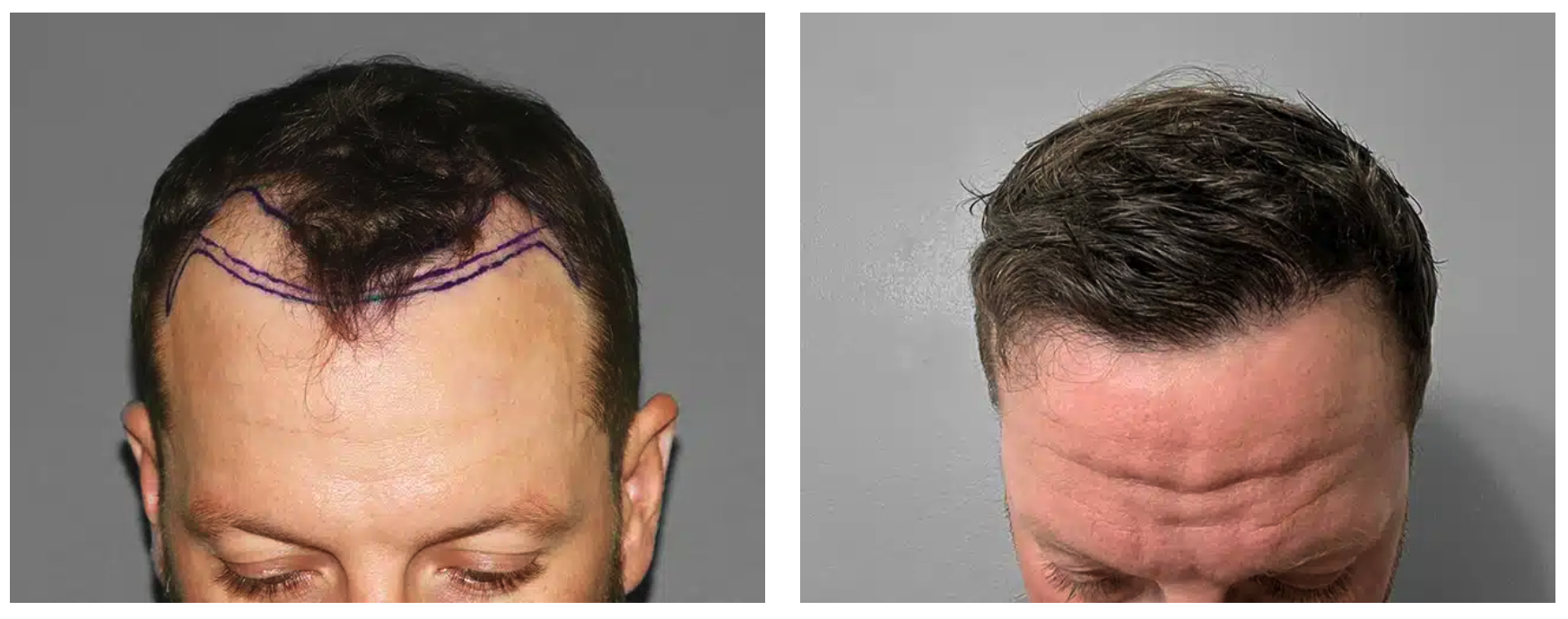 A patient’s hairline before and after restoration with 2,064 grafts.