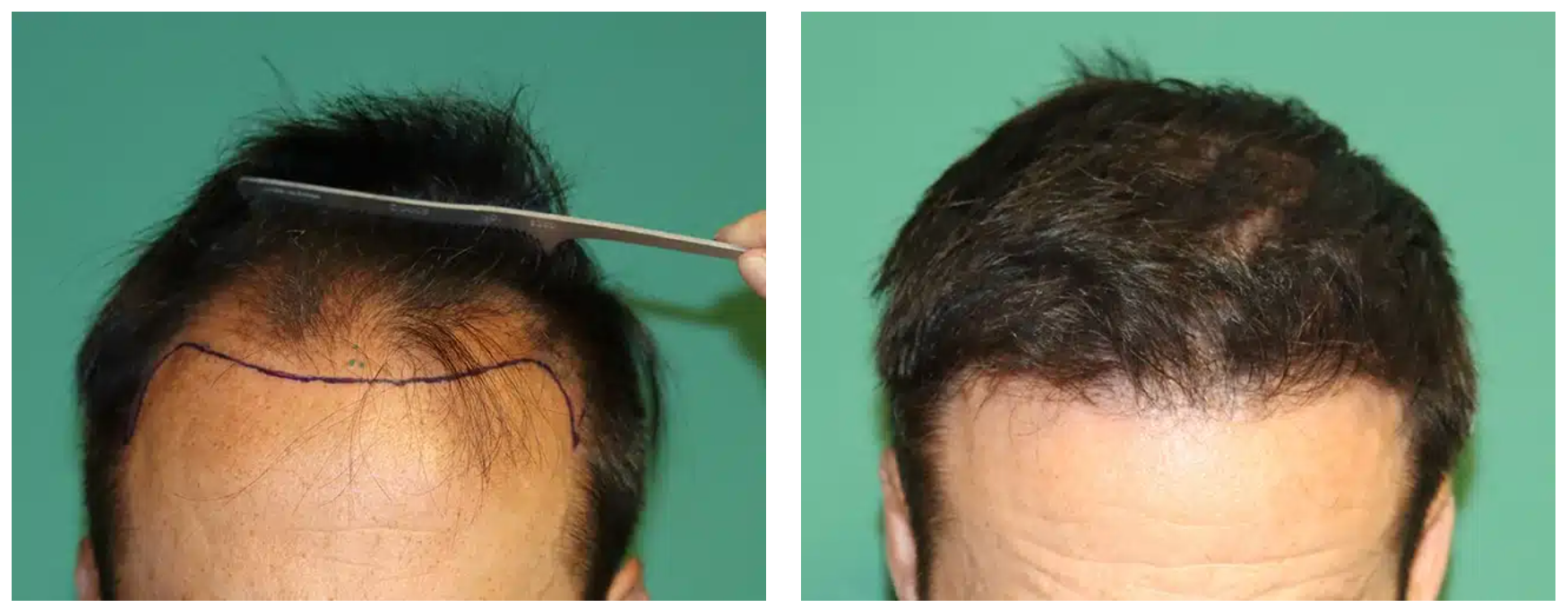 A patient who achieved a full hairline and midscalp restoration with 2,680 grafts.