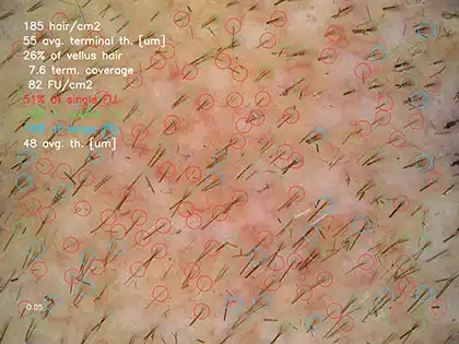 A patient with fine hair follicles (average thickness of 48 µm) who required a higher number of grafts for satisfactory density.