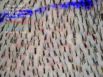 A patient with thick, coarse hair (average thickness of 67 µm) who achieved excellent results with a lesser density