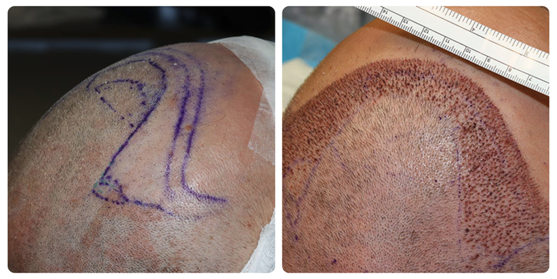 Before and After Hair Transplant