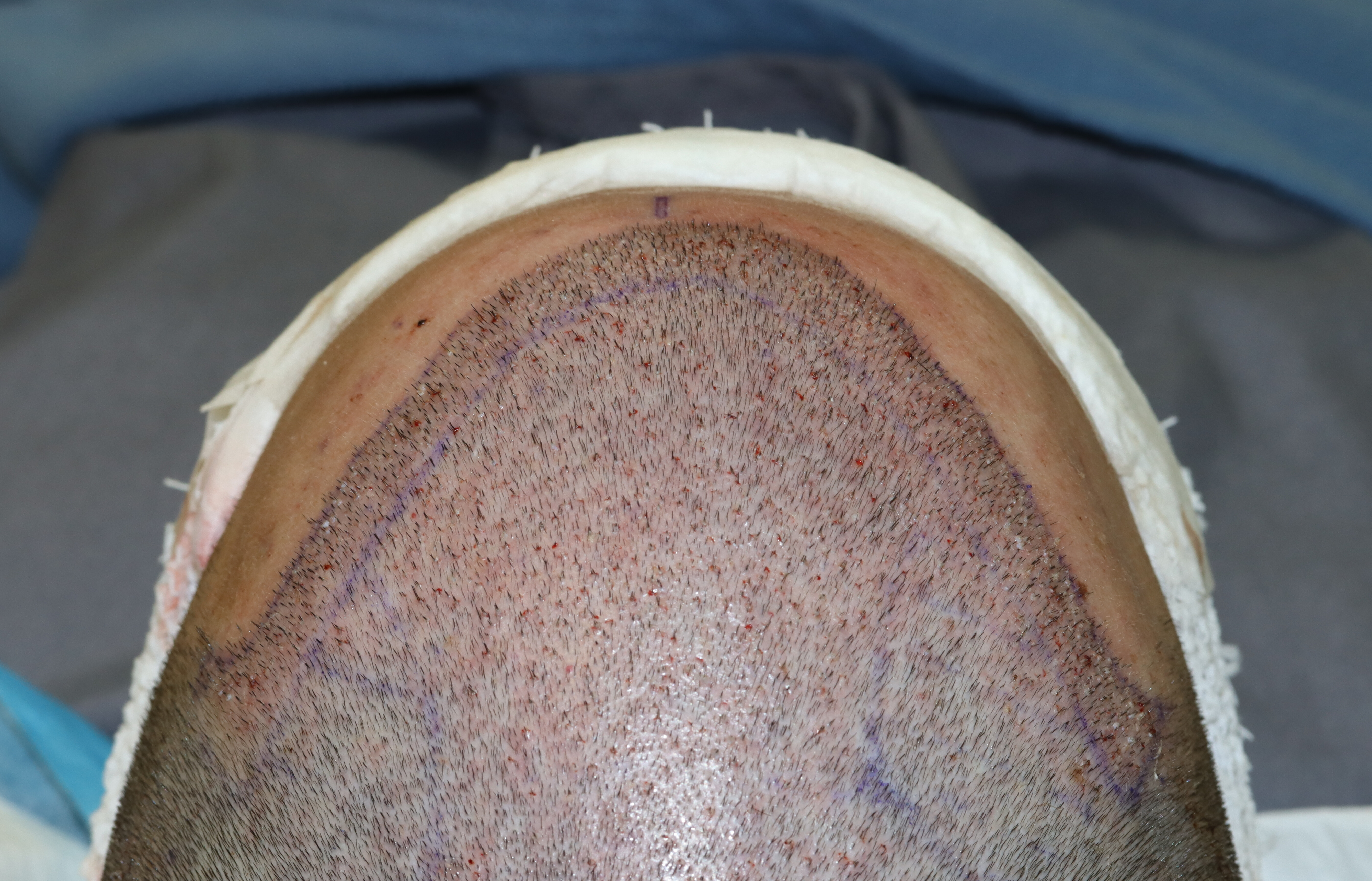 Shaved FUE with precise placement of grafts