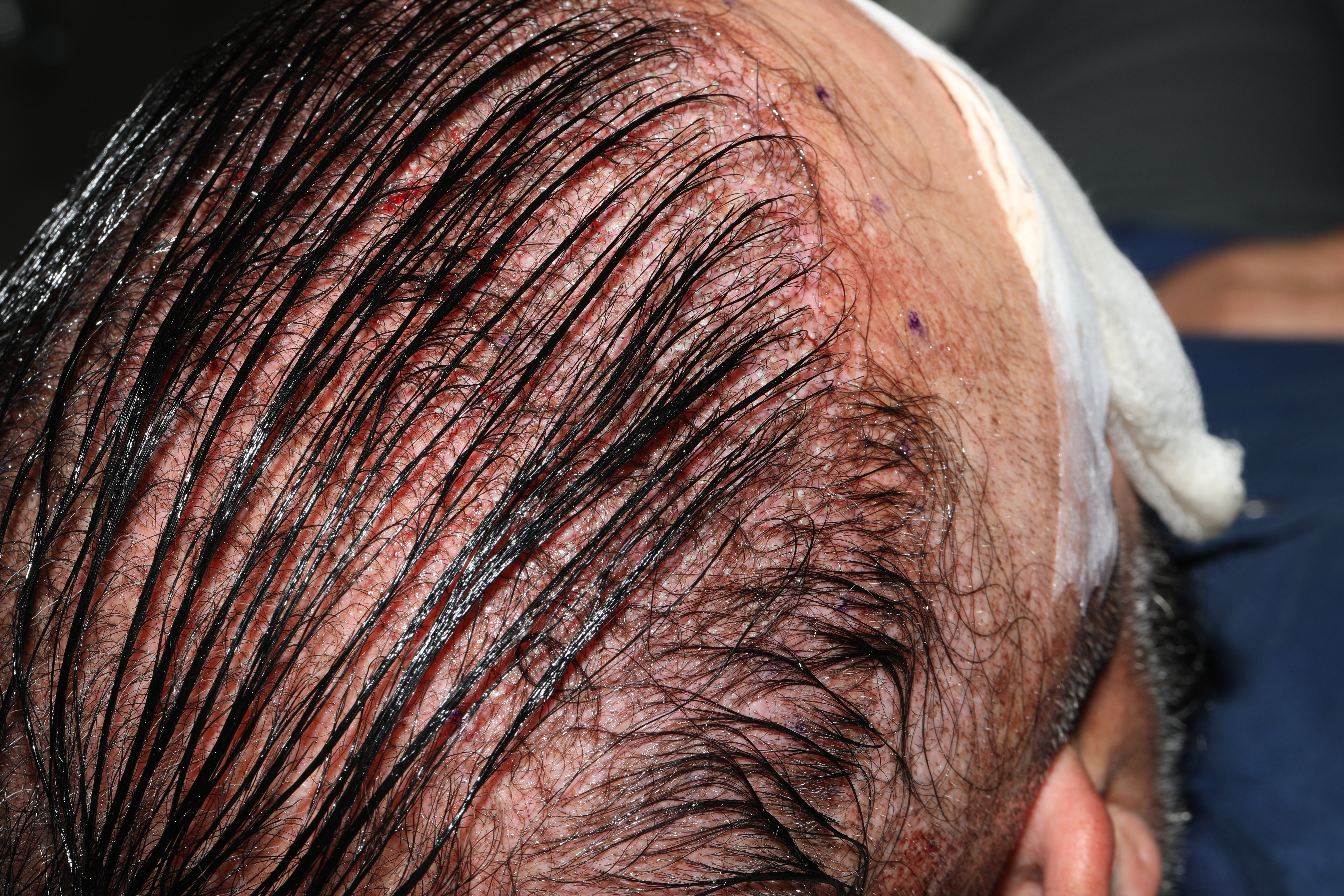 No Shave FUE photo after FUE graft placement