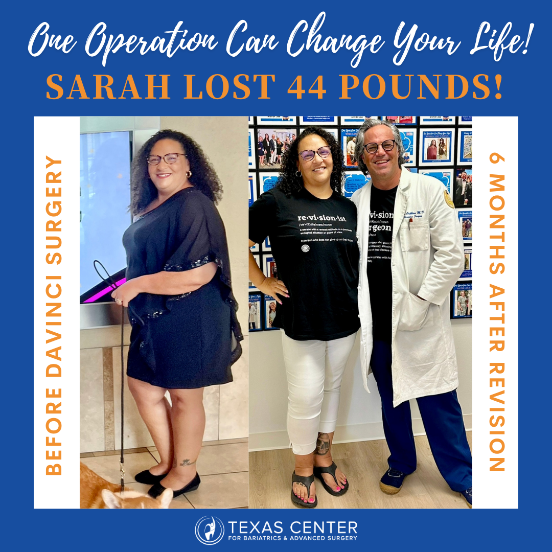 before and after gastric sleeve revision surgery 