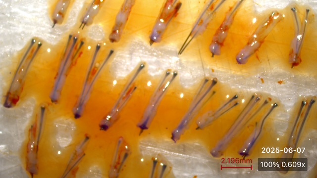 A photo of two and three hair graft follicles at 6x zoom