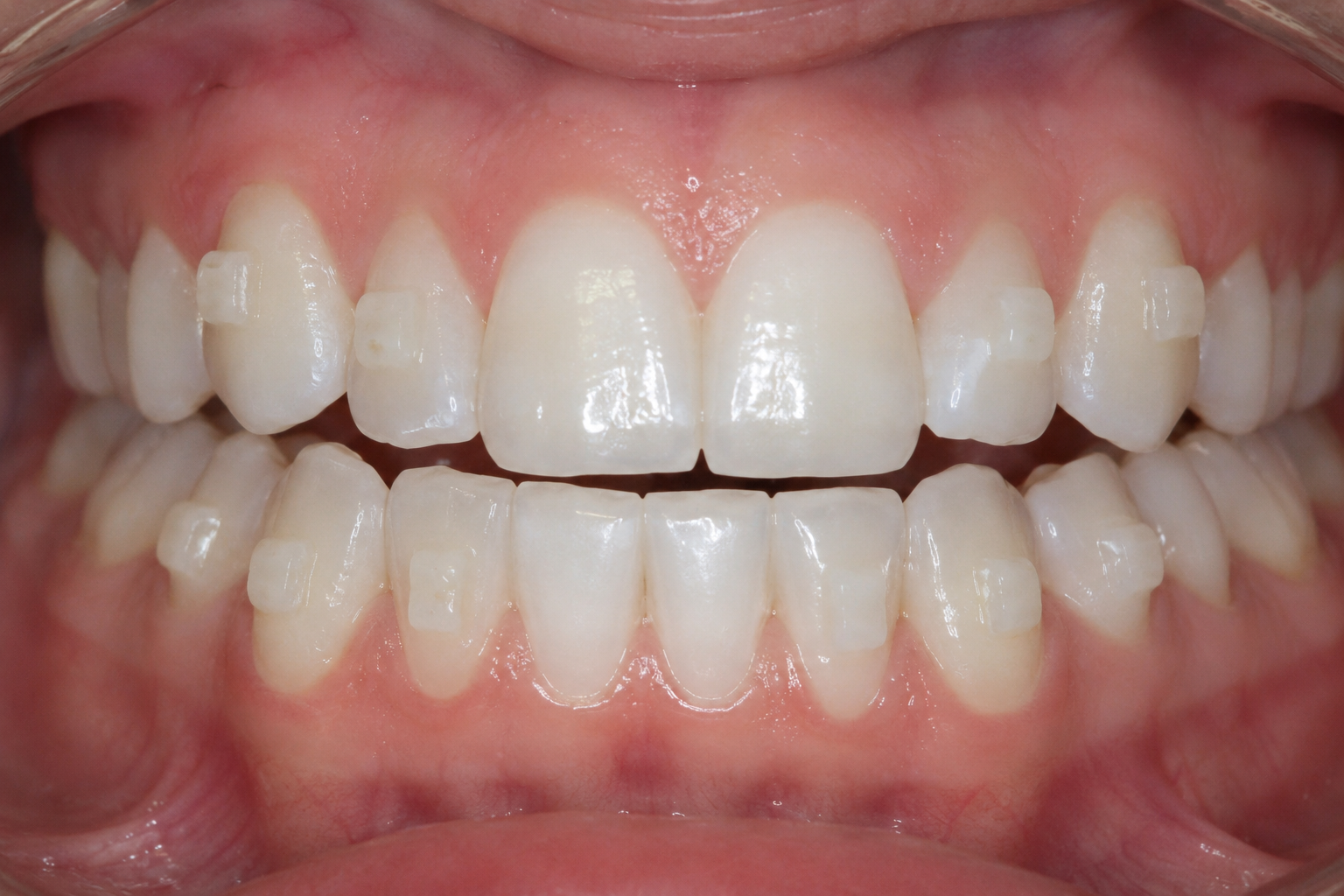 Invisalign attachments on teeth
