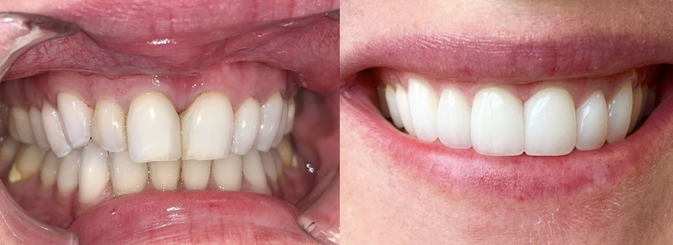 Natural-looking porcelain veneers designed by Dr. Clint Newman