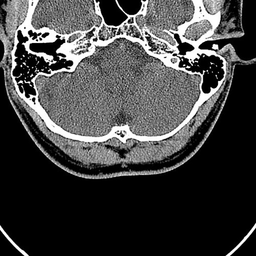 facial skeleton - Skull, Head, and Neck CTs - embodi3D.com