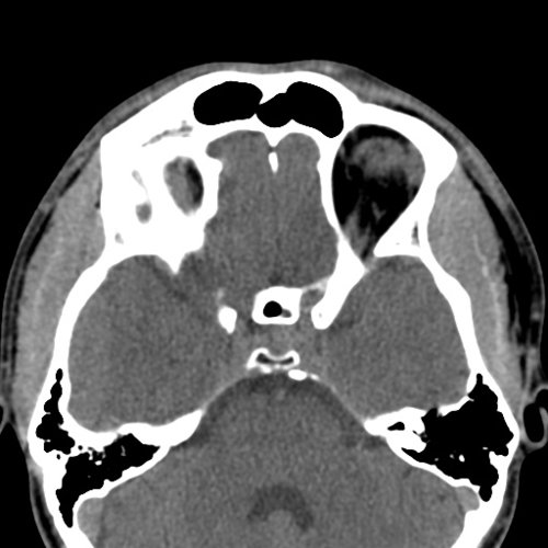 facial skeleton - Skull, Head, and Neck CTs - embodi3D.com