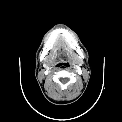 Muscle CT scan neck - Skull, Head, and Neck CTs - embodi3D.com