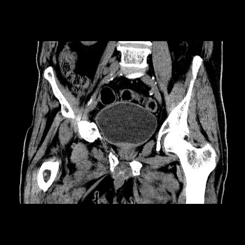 Test CTA file 2 Abdomen and Pelvis CTs