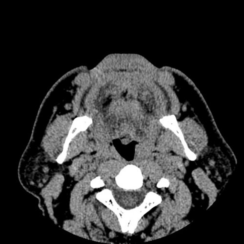 Skull after upper Mandible Bone replacement 072020 - Skull, Head, and