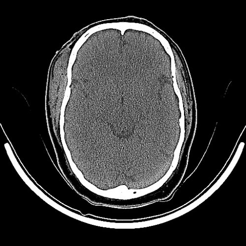 SKULL BONE - Skull, Head, and Neck CTs - embodi3D.com