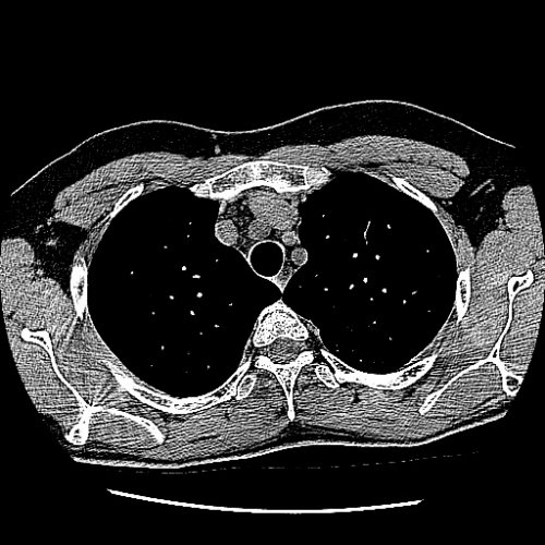 lung ct - Thorax CTs - embodi3D.com