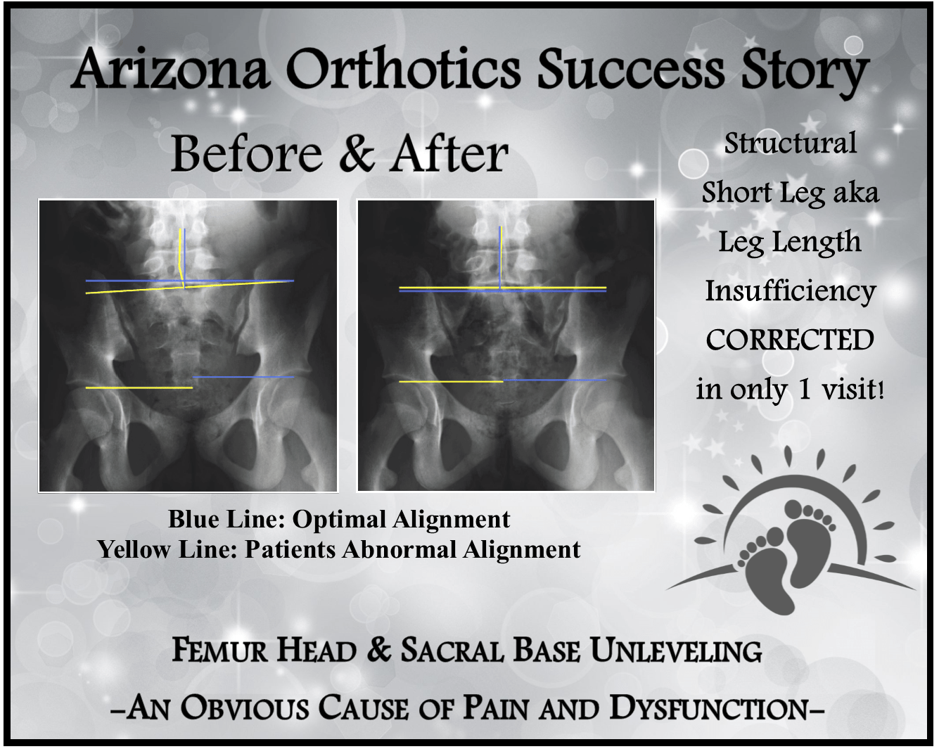 before and after short leg xray pics