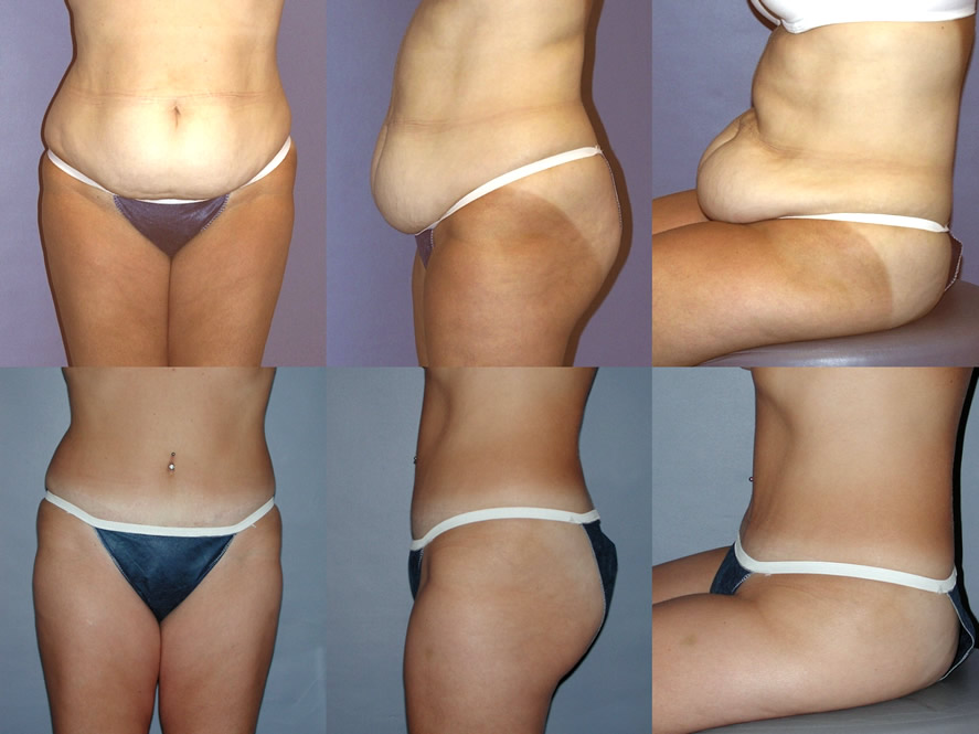 Blepharoplasty Surgery Tampa