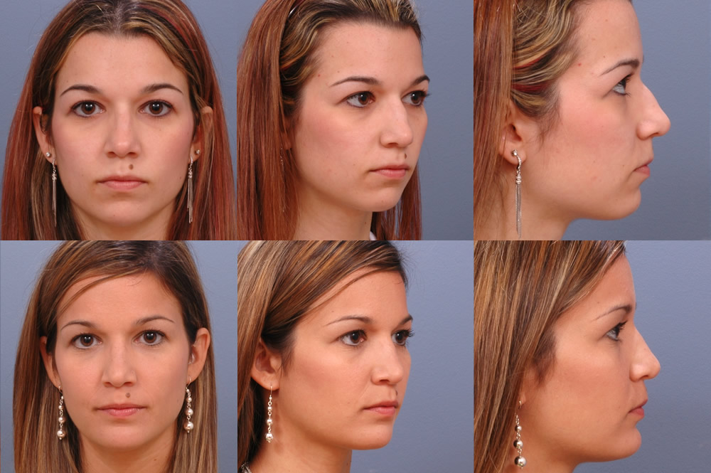 Rhinoplasty