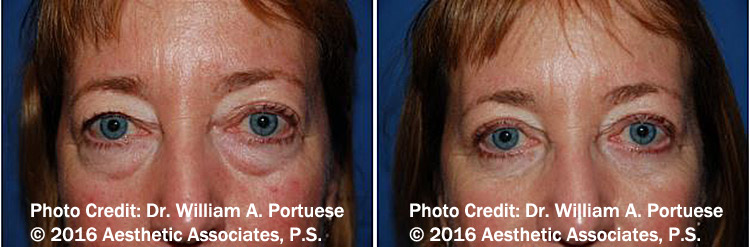 Top Blepharoplasty Surgeon in Portland Oregon