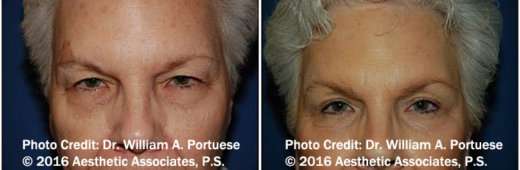 Top Blepharoplasty Surgeon in Portland Oregon