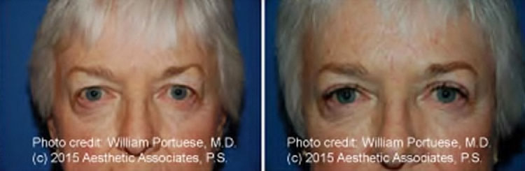 Eyelid Rejuvenation Surgery For Baggy Eyelids