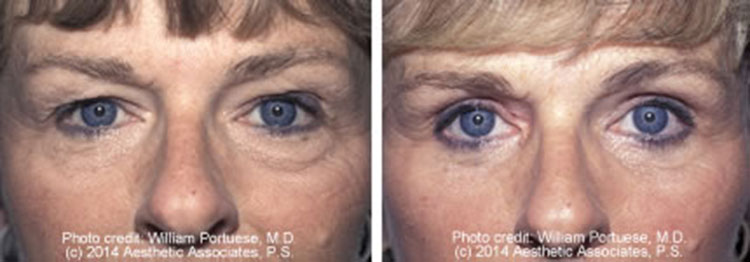 Eyelid Rejuvenation Surgery For Baggy Eyelids