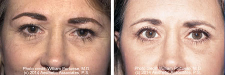 Eyelid Rejuvenation Surgery For Baggy Eyelids