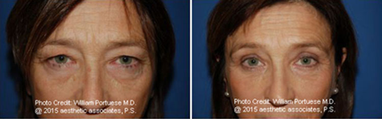 Top Blepharoplasty Surgeon in Portland Oregon
