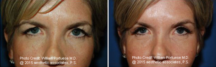 Top Blepharoplasty Surgeon in Portland Oregon