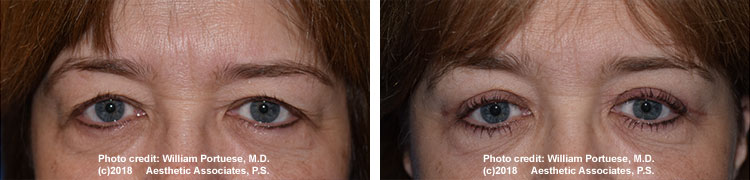 Cosmetic eyelid surgery 