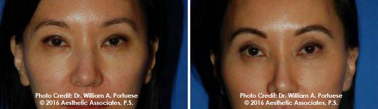 Cosmetic eyelid surgery 