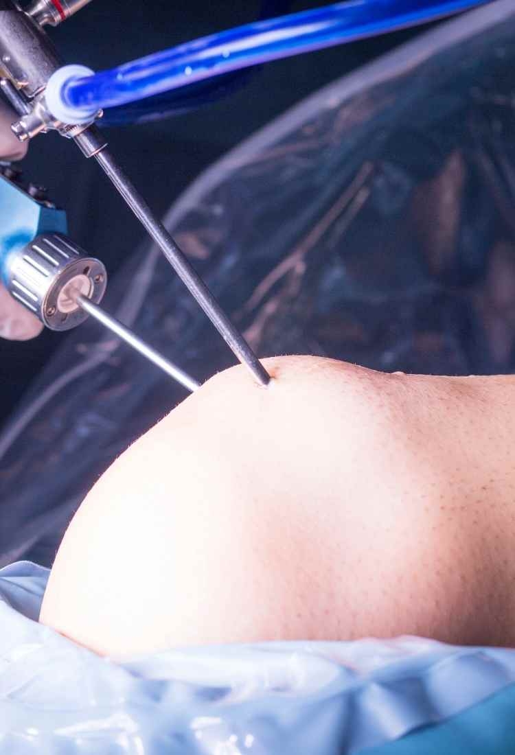 Bariatric Surgery in Monterrey: What to Expect at Obesity Free