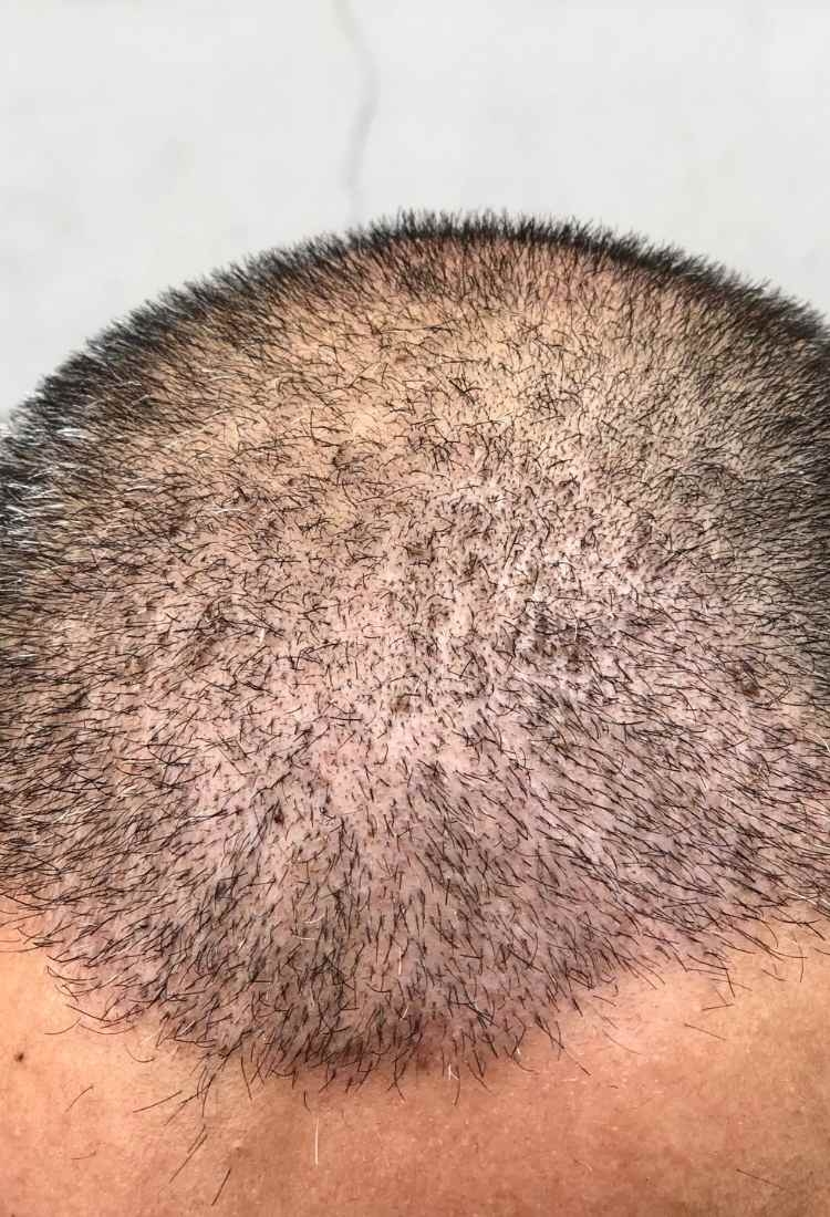 Hairline Restoration and Hair Transplants at Vantage Clinic