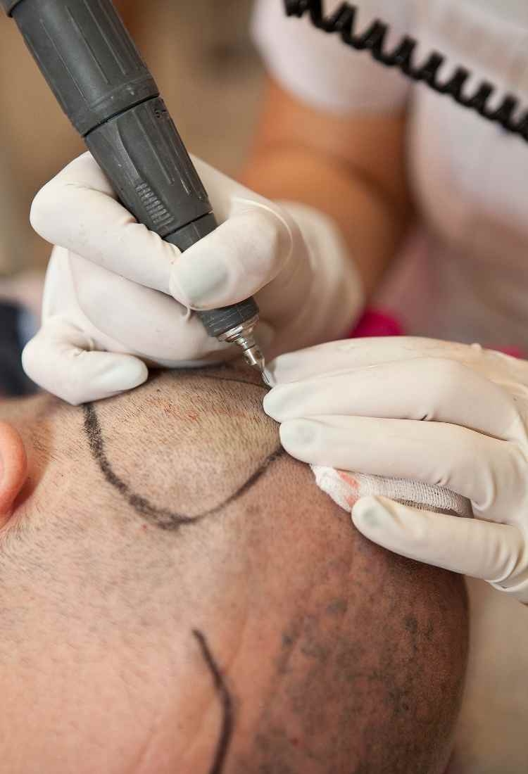 Achieve Natural-Looking Hair at Seneca Hair Transplant Clinic