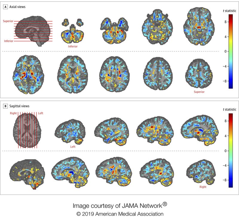 Diplomats' brain scans show differences, add to Cuba mystery | FACTSWANTED Diplomats' brain scans show differences, add to Cuba mystery | FACTSWANTED