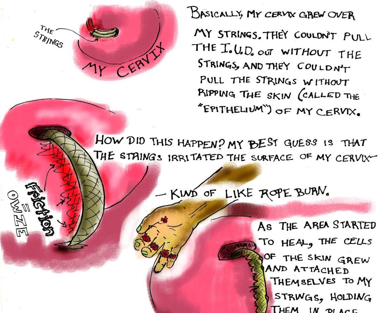 Family Lore - Episode 2, Page 5: Julia's Intra-Uterine Device